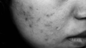 acne scars